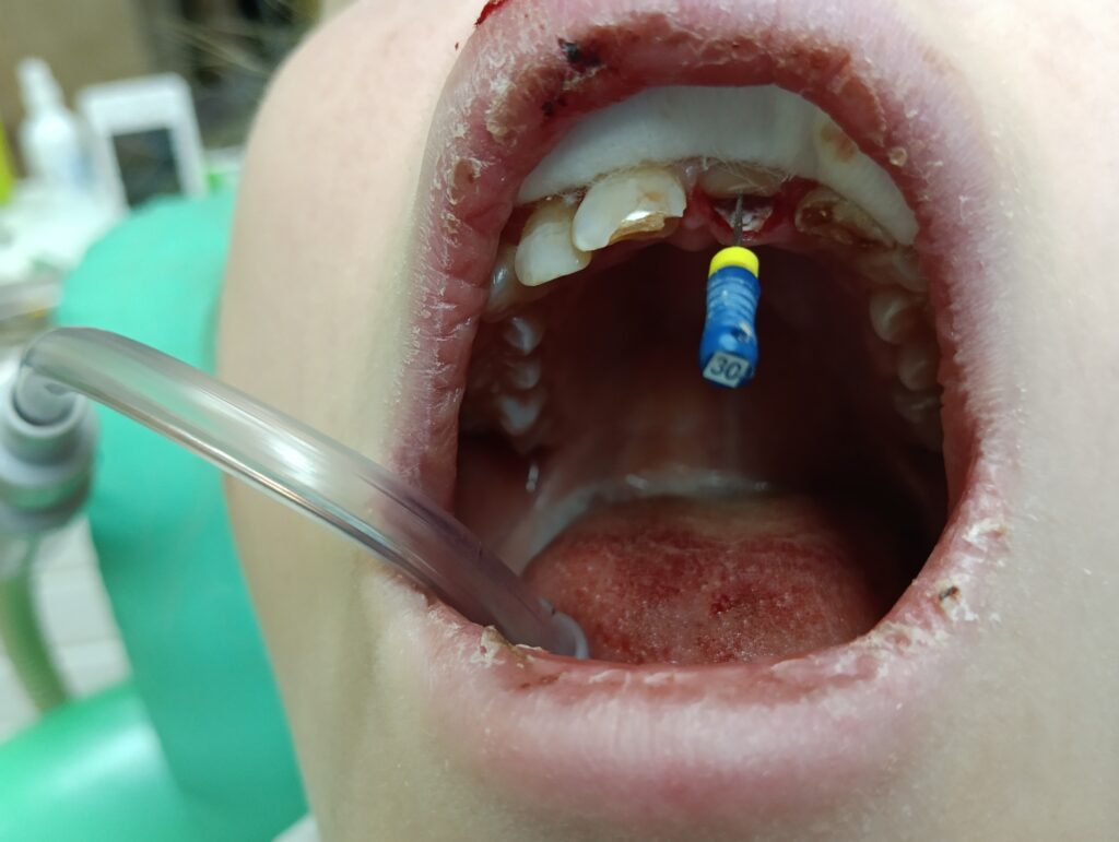 Травма зуба 21. Перелом коронки с повреждением пульпы