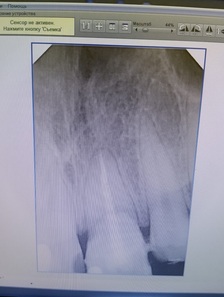 Контрольный снимок пломбирования корневого канала 21 зуба