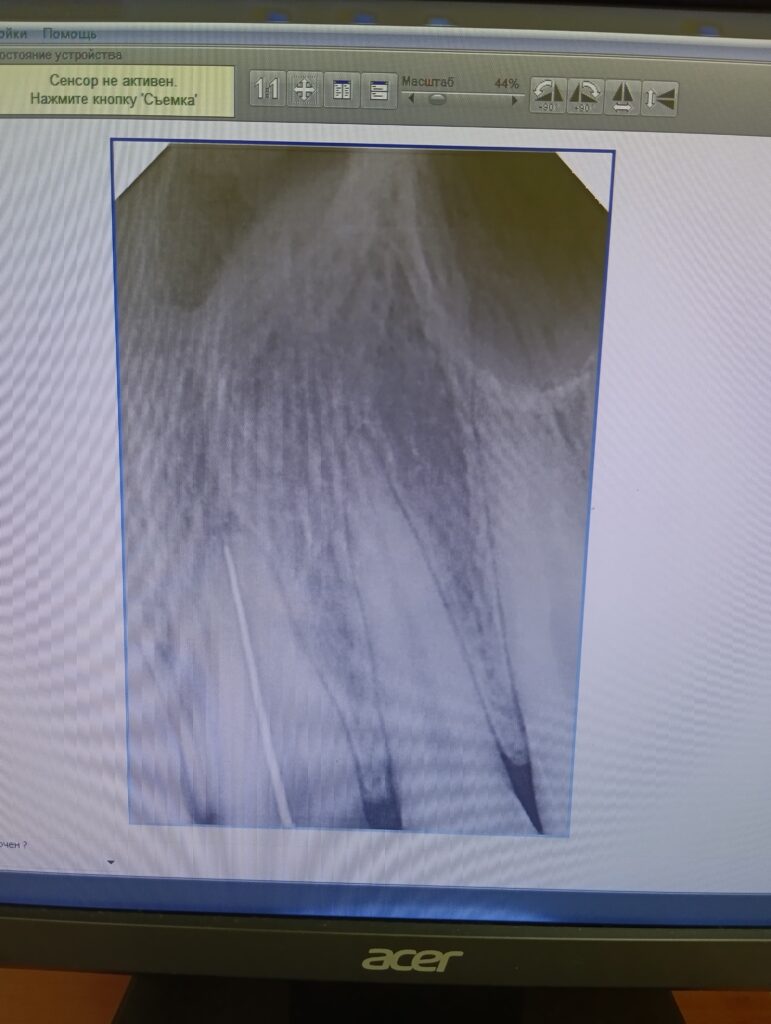 Рентгеновский снимок 21 зуба с к-файлом