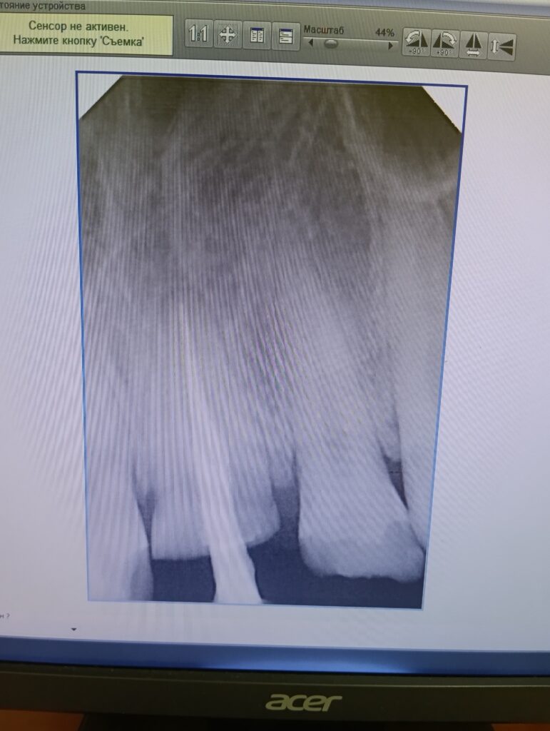 Травма зуба 21. Перелом коронки с повреждением пульпы