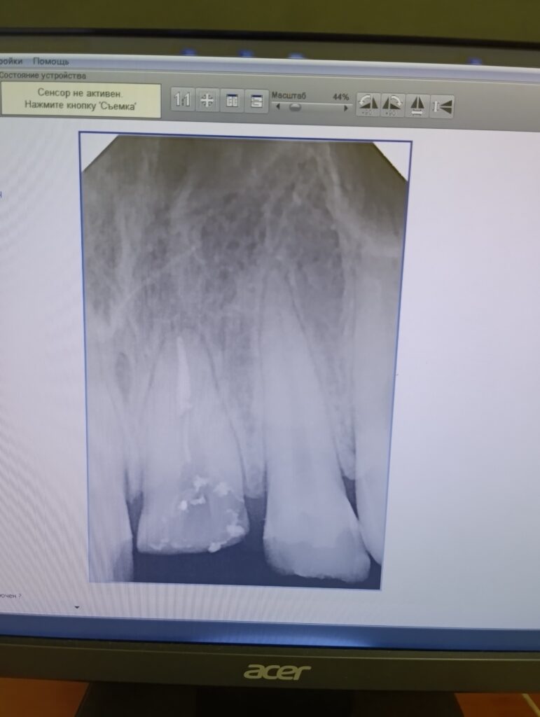 Рентген 21 зуба с подготовленным коневым каналом для фиксации титанового штифта
