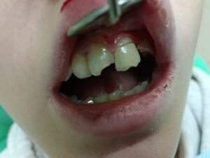 Травма зуба 21, перелом коронковой части
