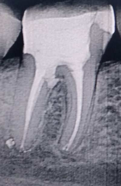 Рентген снимок 46 зуба через год