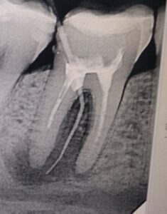 Рентген снимок 46 зуба. Межкорневая киста 46 зуба.