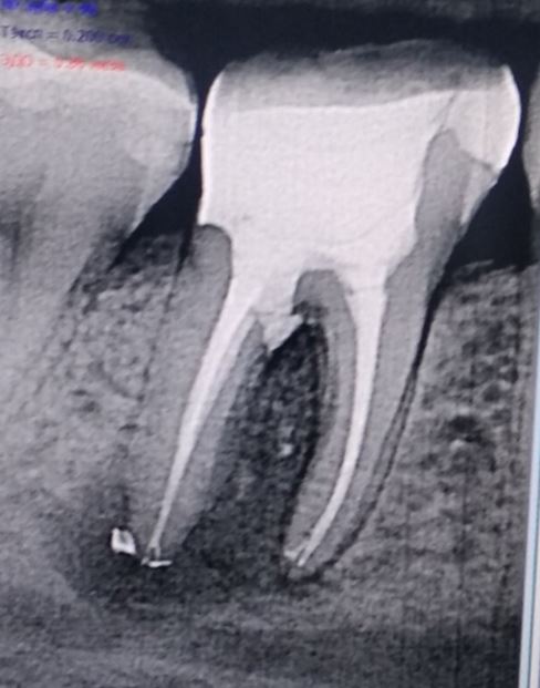 Рентген 46 зуба с закрытой перфорацией и запломбированными корневыми каналами.