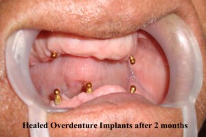 Дентальные импланты через 2 месяца после установки в полости рта