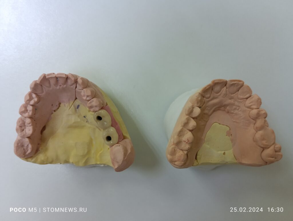 Металлокерамические коронки на 45, 46 зубе для последующей имплантации