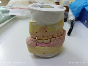 Металлокерамические коронки на 45, 46 зубе для последующей имплантации