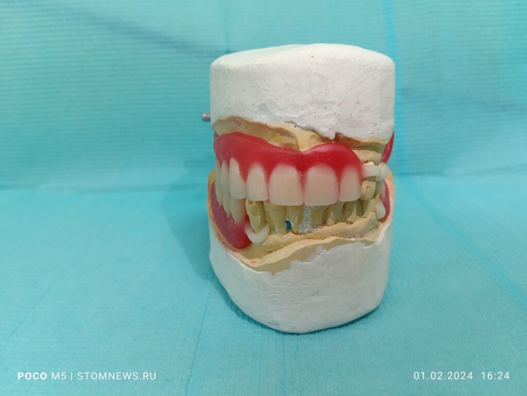 Виды съемных и несъемных зубных протезов. Съемный ацеталовый протез вид спереди