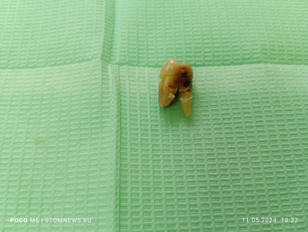 Удаленный 17 зуб парадонтозный