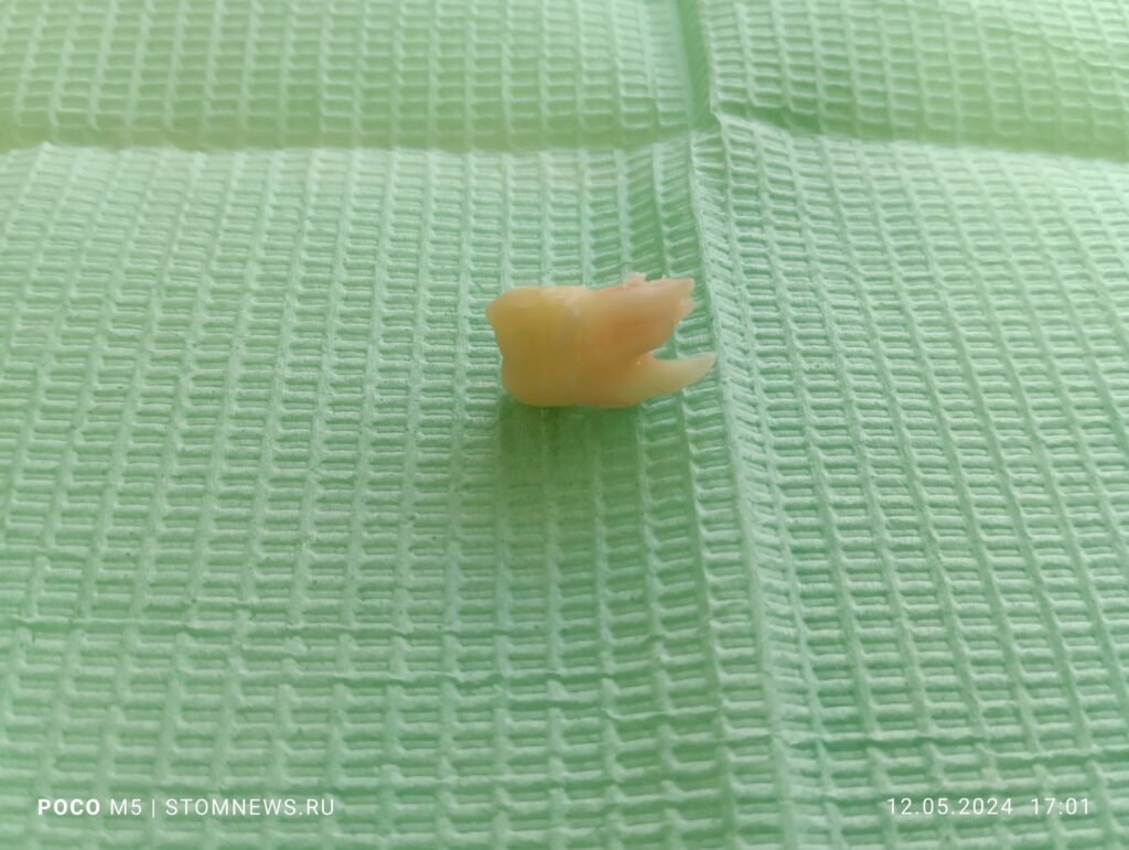 Удаленный 1.8 зуб мудрости с кусочками костной ткани