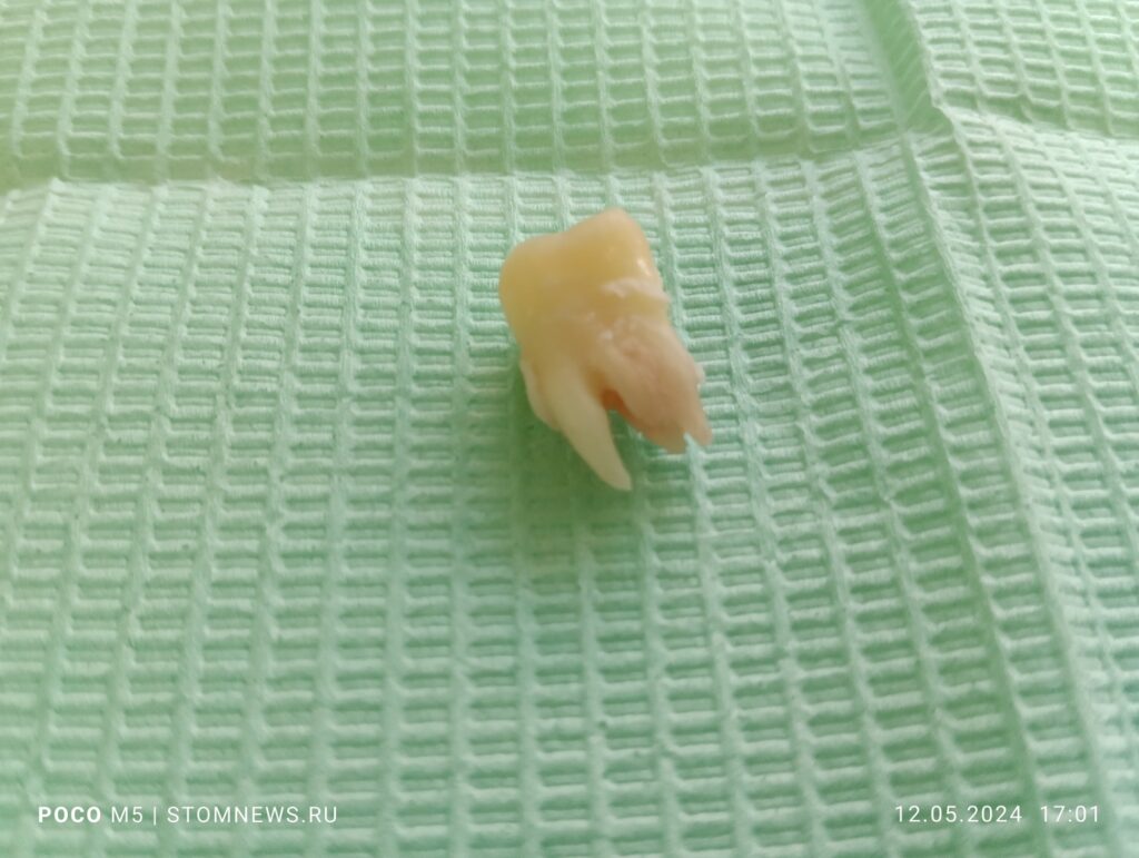 Удаленный 1.8 зуб мудрости с кусочками костной ткани