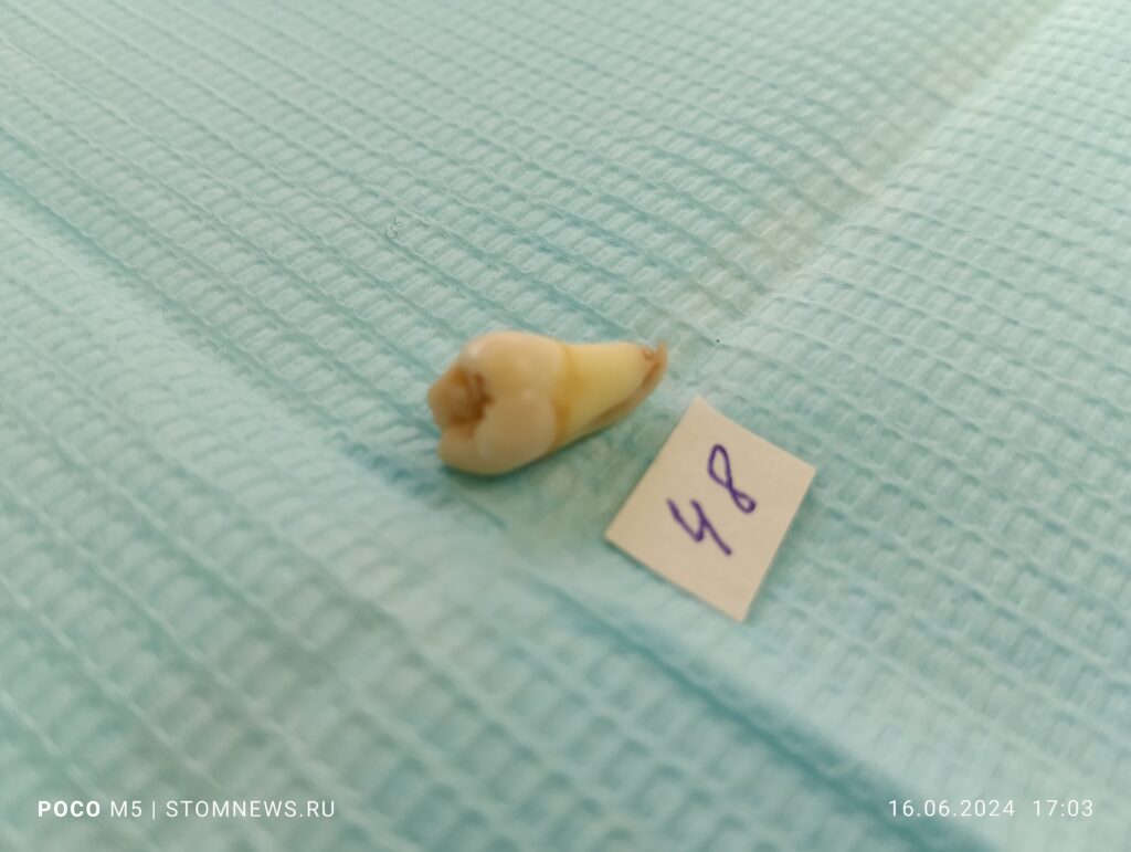 Фотографии удаленного 48 зуба с изогнутым кончиком на верхушке корня